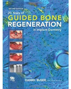 20 Years of Guided Bone Regeneration in Implant Dentistry